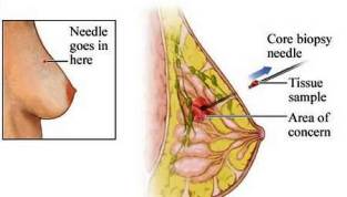 http://noboobsaboutit.org/breast-cancer-2/core-needle-biopsy-may-result-in-under-staging-of-breast-cancer/